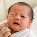 Signs of Facial Nerve Palsy in Newborn Babies: Uneven Crying, Facial Drooping, Incomplete Eye Closure, and Feeding Difficulties